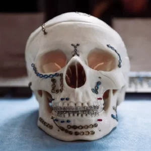 Maxillofacial-Skull-With-Stitches-and-Implants