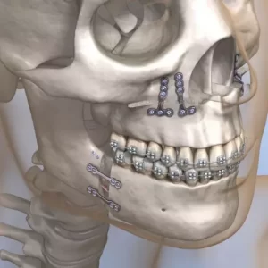 Maxillofacial-Skull